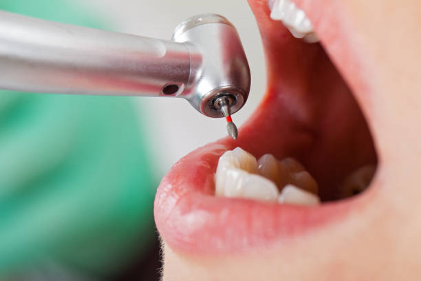 Best Tooth Infection Emergency Dentist  in West Slope, OR